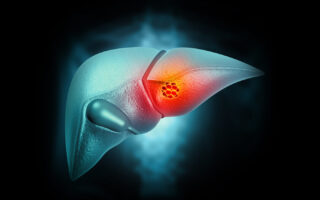 HCC Risk Factors: Early Intervention Strategies to Reduce Disease Burden