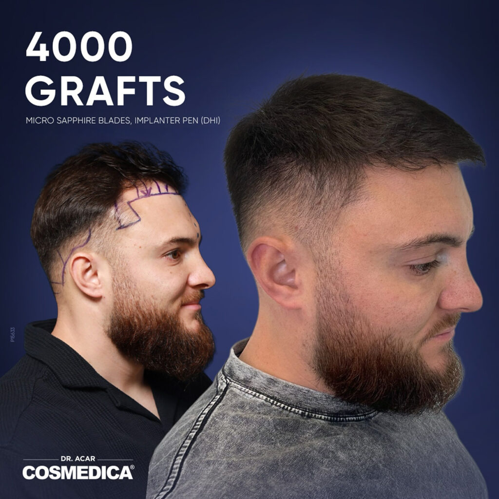 Before and after results of a Micro Sapphire hair transplant in Turkey at Cosmedica Clinic.