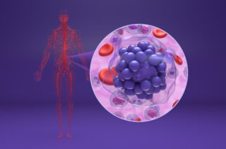 Zanubrutinib Use in Relapsed or Refractory B-Cell Malignancies: Research Insights