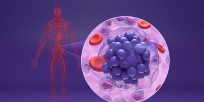 Zanubrutinib Use in Relapsed or Refractory B-Cell Malignancies: Research Insights